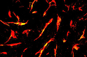 UCLA Researchers Engineer CAR-T Cells to Target Hard-to-Treat Solid Tumors