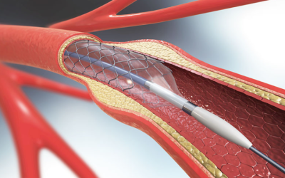 UCLA Researchers Develop Smart Stent to Track Blood Flow in Real Time