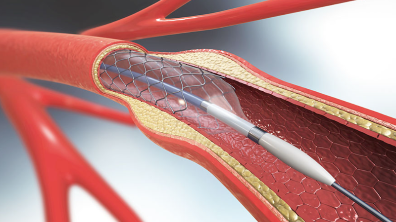 A smart stent inserted into the cross-section of an artery. 