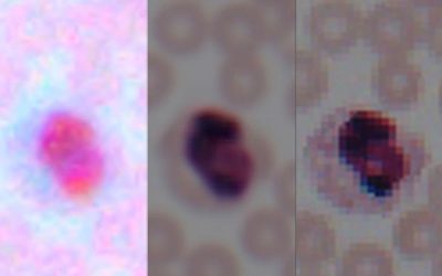 Deep learning transforms smartphone microscopes into laboratory-grade devices